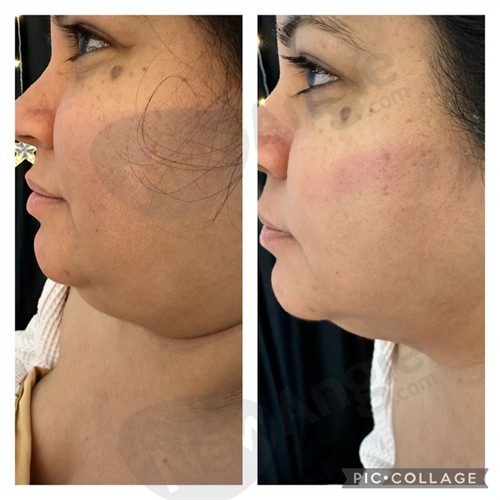 Gallery Image neck_contouring.jpg