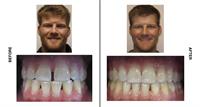 Patrick - before and after (treated with Invisalign)