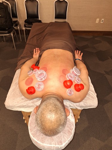 Cupping helps circulation and range of motion