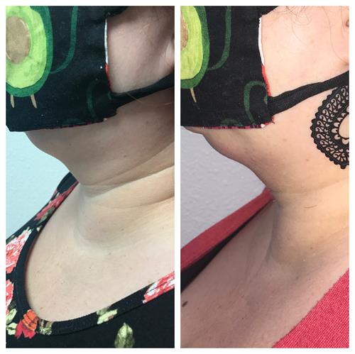 Before and After Cryo Slimmming on neck