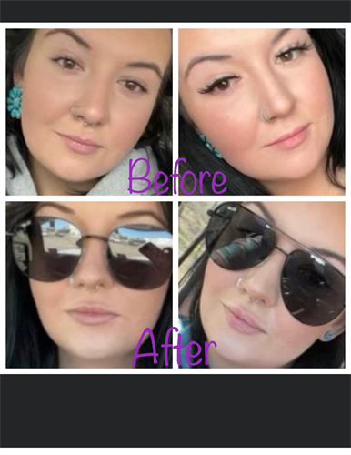 LIP AUGMENTATION WITH DERMAL FILLERS