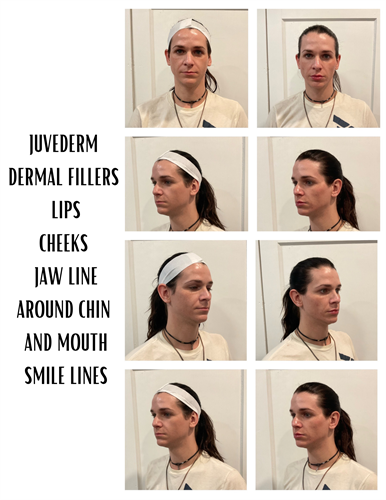 TOTAL FACIAL AUGMENTATION WITH DERMAL FILLERS