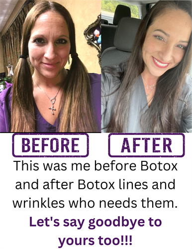 BEFORE AND AFTER BOTOX TREATMENT AND SKINCARE REGIMEN 