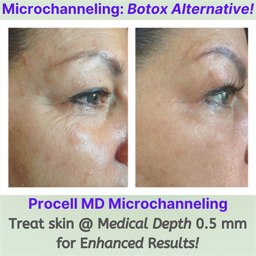 Wrinkle Reduction & Collagen Growth with Procell Microchanneling with Exosomes