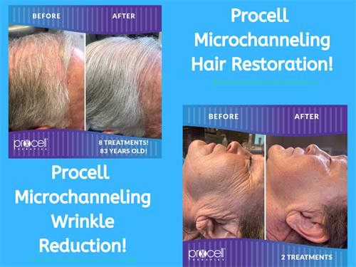 Microchanneling/Microneedling with Exosomes for Hair Restoration 