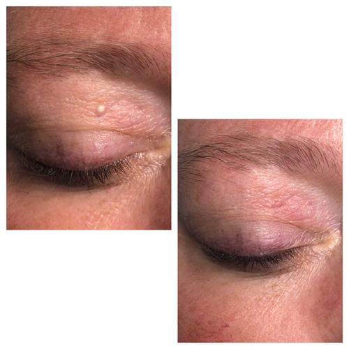 Before & After Milia Removal (immediately post treatment)