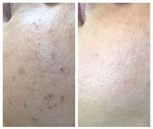 Before & After Treatment for hyperpigmentation (4 weeks post treatment)