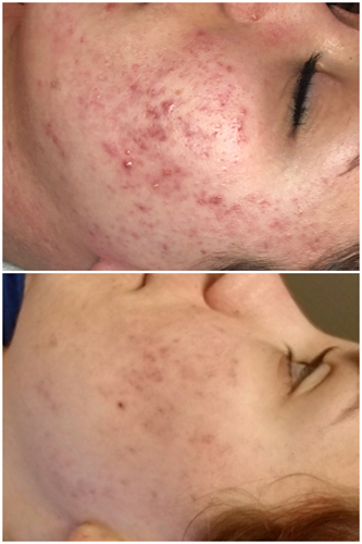 Before & After Acne treatment (2 day post treatment)