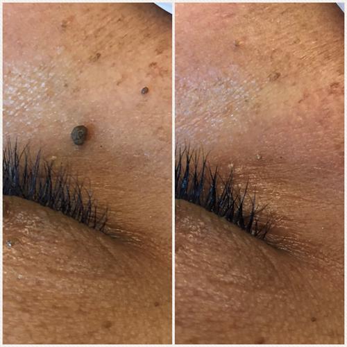 Before & After Skin Tag Removal (immediately post treatment)