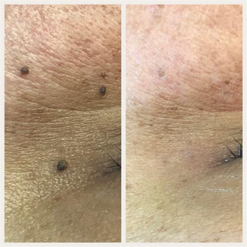 Before & After Skin Tag removal (immediately post treatment)