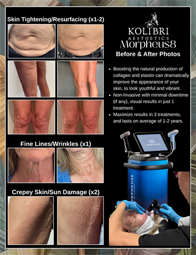 Gallery Image Branded_Morpheus8_Before_and_After_Flyer.png