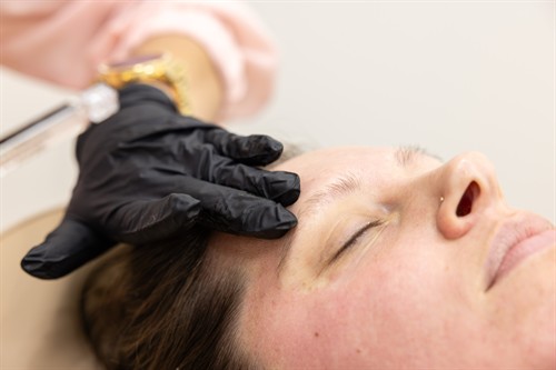 Gallery Image Microneedling_Post.jpg