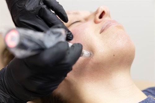 Gallery Image Microneedling_Post_1(1).jpg