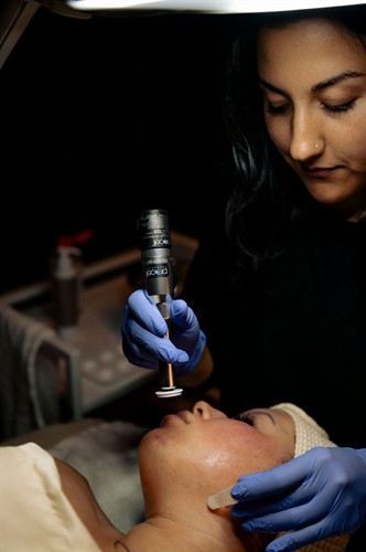 Microneedling