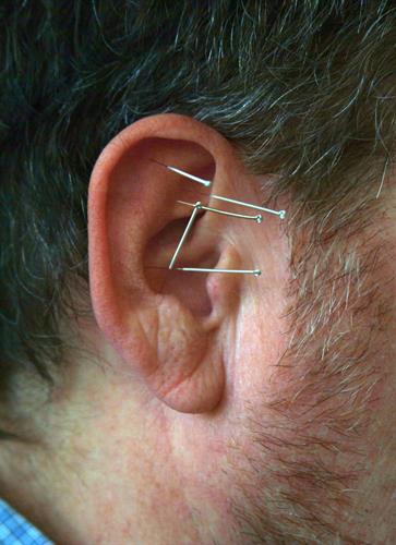 Ear needles