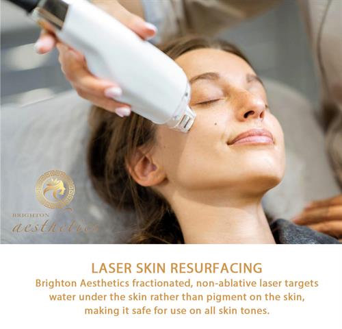 LASEMD LASER SKIN RESURFACING Safe Year-Round for ANY Skin Type LaseMD is a non-ablative fractional laser that rebuilds skin, rejuvenate pigmented skin, and resurface fine lines and wrinkles. Target hyperpigmentation including melasma, post-inflammatory hyperpigmentation, and dark scars, acne, freckles, UV sun damage, actinic keratosis, wrinkles, and age spots. 
