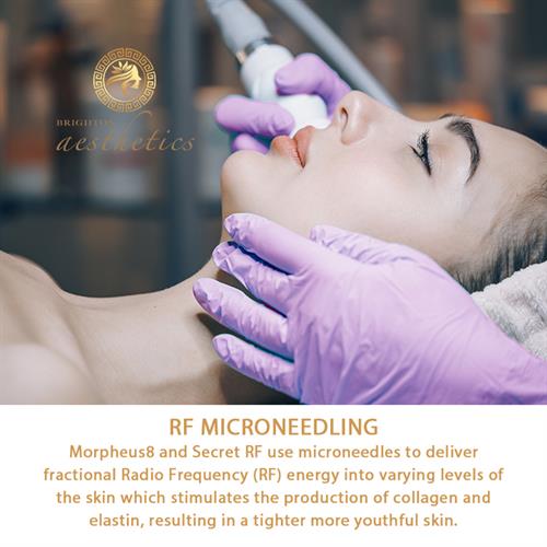 RF MICRONEEDLING Morpheus8 and Secret RF use microneedles to deliver fractional Radio Frequency (RF) energy into varying levels of the skin which stimulates the production of collagen and elastin, resulting in a tighter more youthful skin.