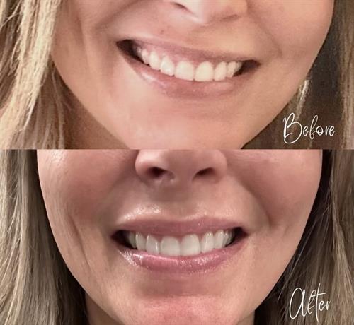 Lip Flip Before & After