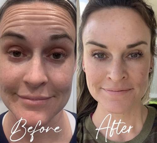 Forehead Before & After