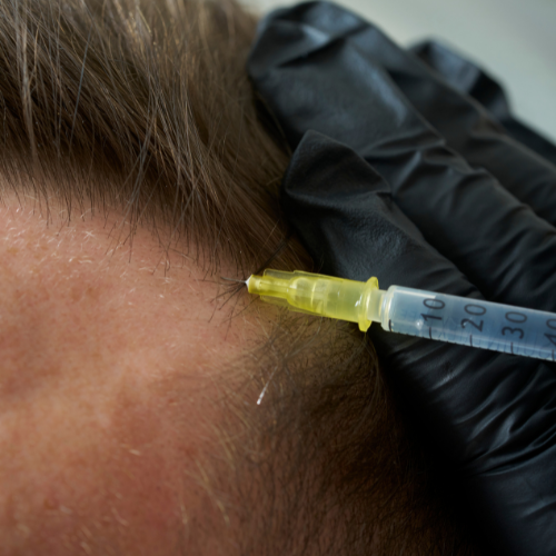 PRP uses your own platelet-rich plasma to support the hair follicle and encourage healthier growth. A regenerative approach to thinning hair, delivered over a tailored course — with realistic expectations set from your very first visit.