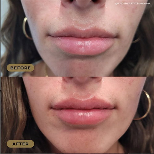 Lip Filler 