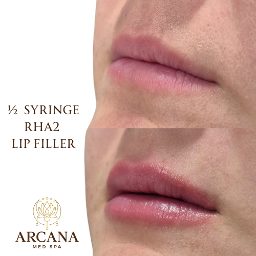 Subtle Lip Enhancement and Hydration with RHA Dermal Filler