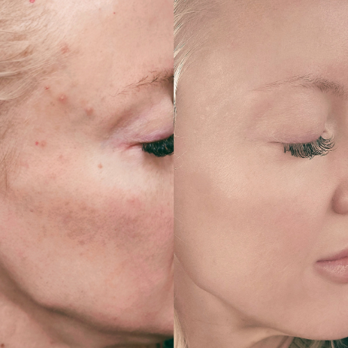 Address Acne, Pigmentation, Oily Skin, Texture, & More