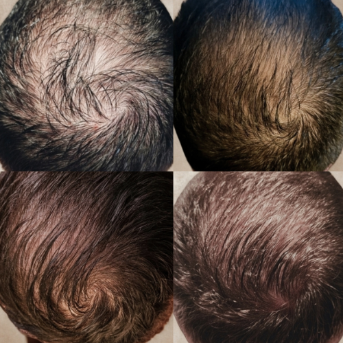Hair Restoration Microneedling Can Help Bring Life Back to your Follicles