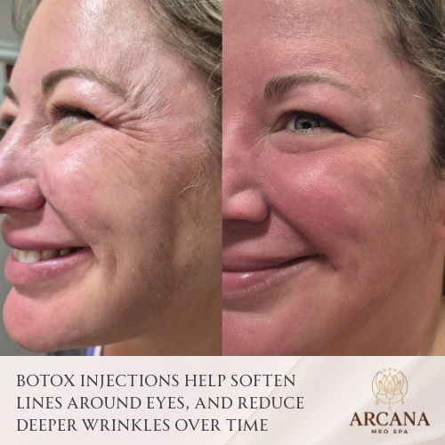 Botox Injections For Wrinkle Treatment + Prevention