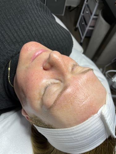 Radiant skin after our BMC Luxe Dermaplane Facial