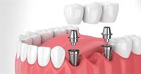Dental Implants near Alpharetta, GA for only $1000