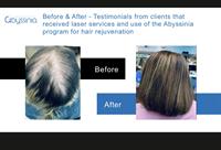 Abyssinia Hair and Beauty Clinic | Hair Restoration Clinic - Renton