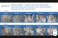 Abyssinia Hair and Beauty Clinic | Hair Restoration Clinic - Renton