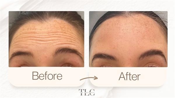 Tox those fine lines