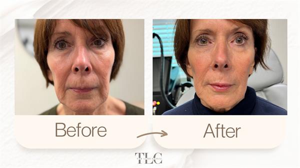 Sculptra, ADVAtx laser, PDO threads