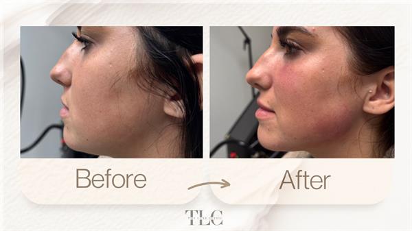 Liquid Face Lift to help with facial balancing and jaw definition