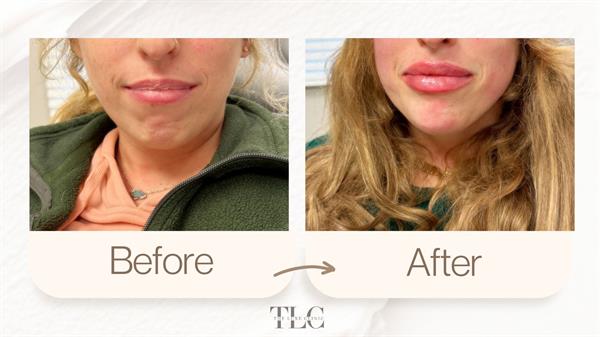 Lip and Chin Filler