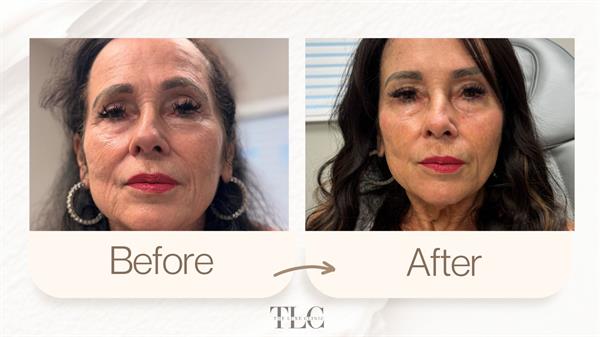 PDO threads and facial filler