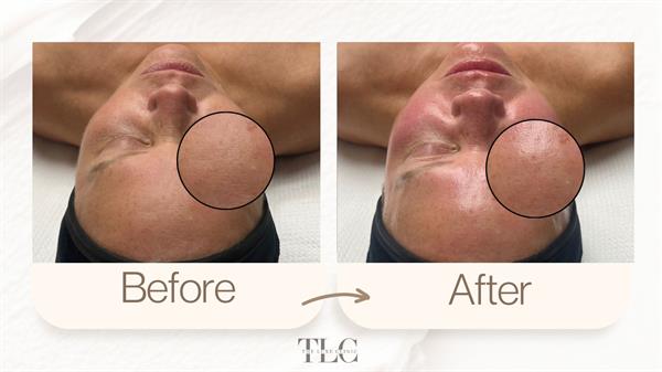 GLO2Facial with RF results