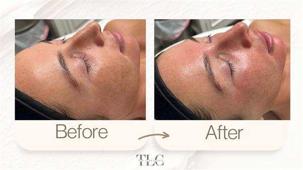 GLO2Facial wih RF results