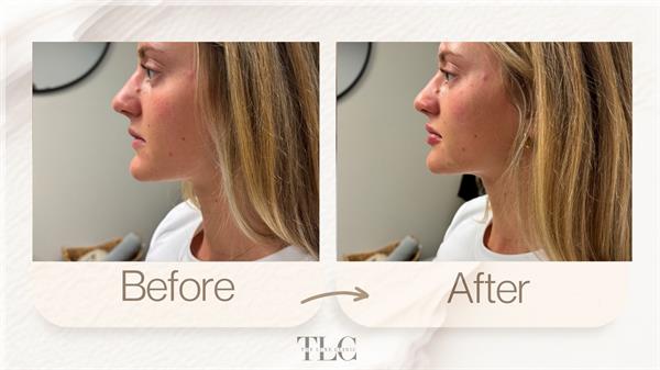 Facial balancing with lip and chin filler