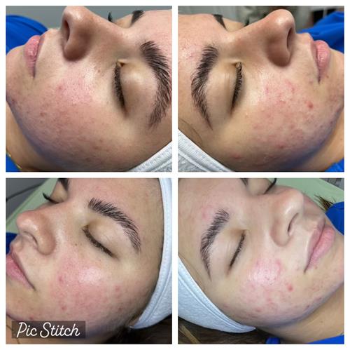 Before and After Skinwave Aquafacial Treatment 