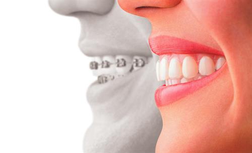 Invisalign and Braces Provider in Brea and Placentia 