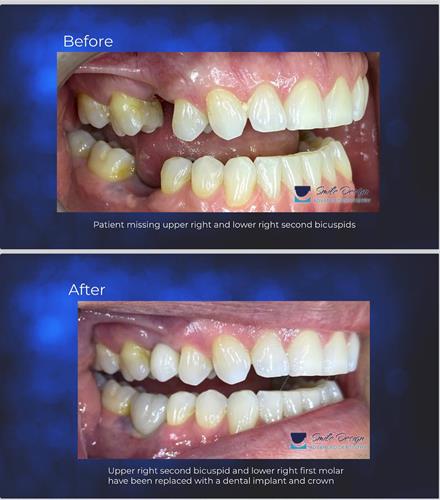 Before and after Dental Implants Brea and placentia 