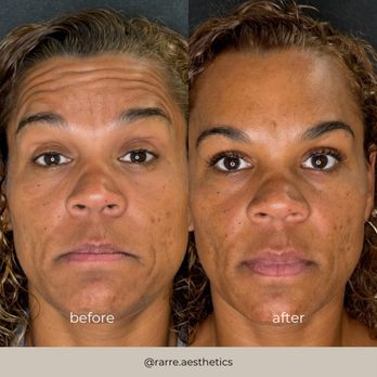 Before and After First Tox Treatment
