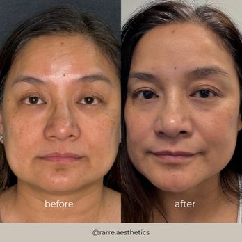 Before and After Skin Reset Duo (Microneedling and ULTRA+ facial)