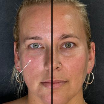Before and After Derma PRP Treatment (1 Session)