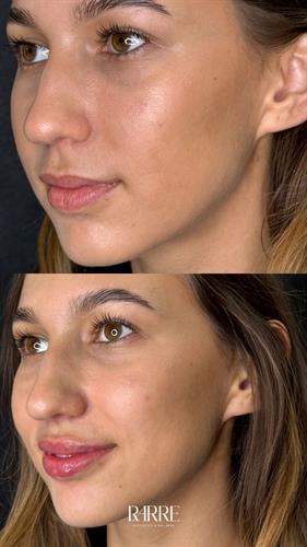 Before and After First LIp Filler Treatment