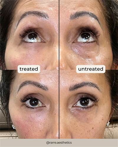 Before and After Derma PRP Treatment (1 Session)