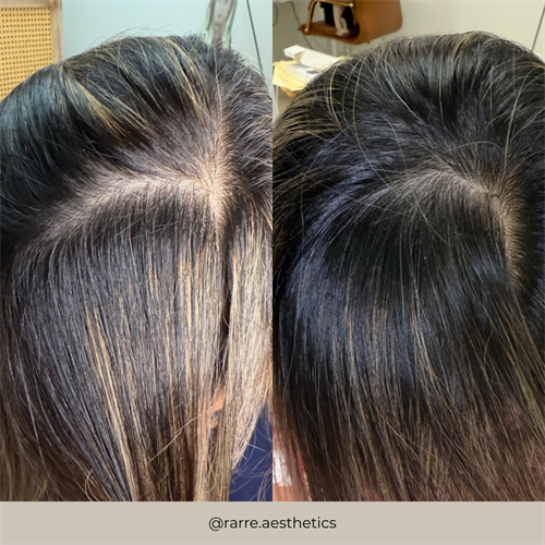 Before and After Hair Restoration using ULTRA+ and Plant-Based Exosomes